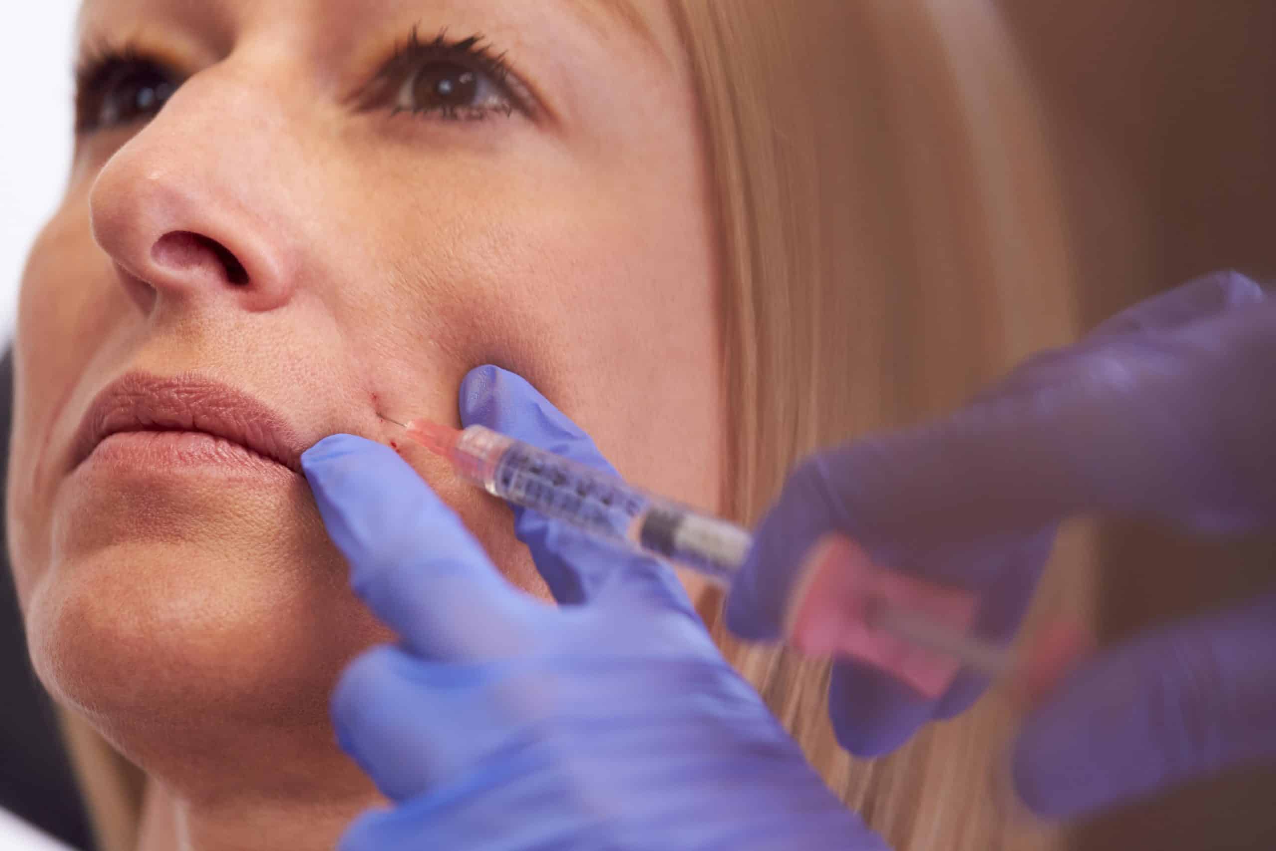 Dermal Fillers After Weight Loss - Injectco